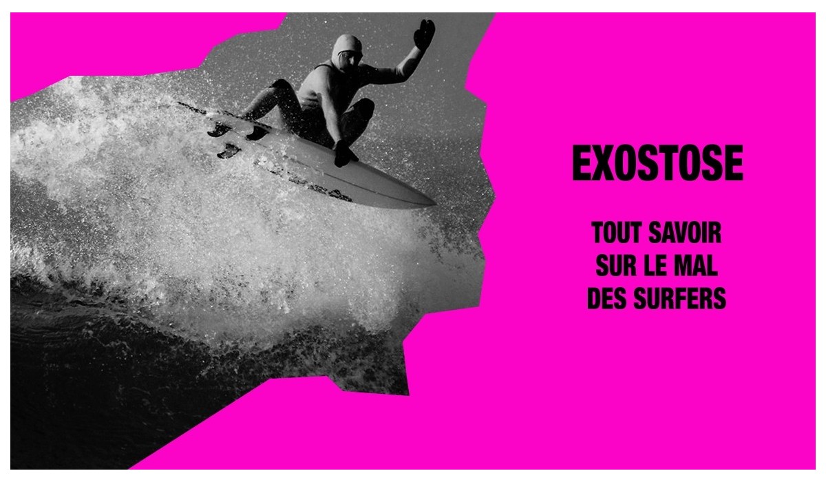 Exostose et surf : comment continuer à surfer malgré tout